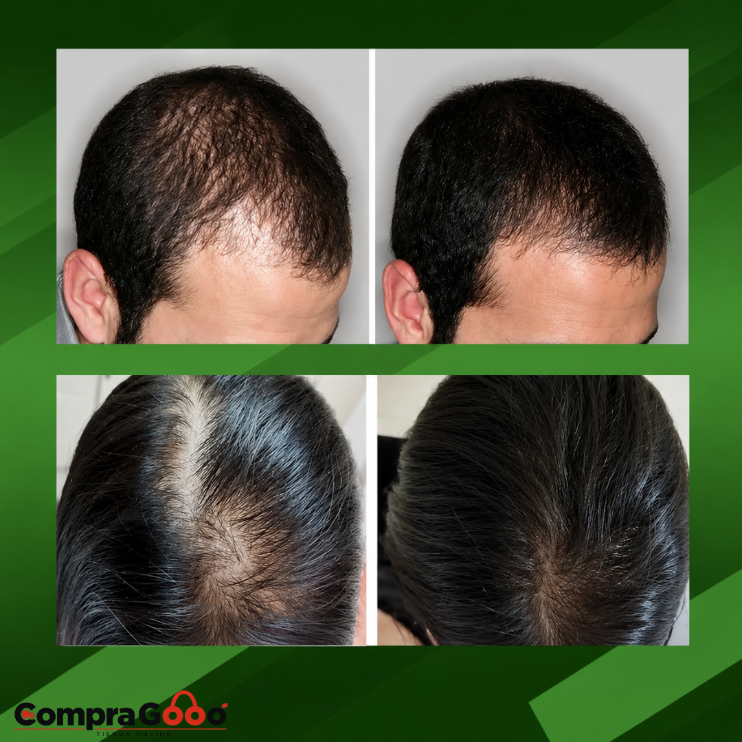 SUPER COMBO CAPILAR OUHOE 100ML+ DERMA ROLLER